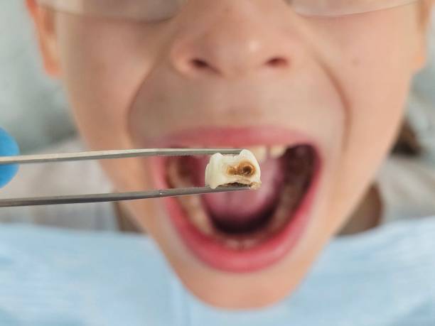 Best Knocked-Out Tooth (Avulsed Tooth) Treatment in Waterville, NY